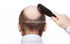 男人脱发是什么原因引起的 男人脱发原因及治疗方法
